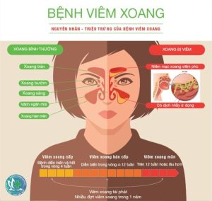 viem xoang 1