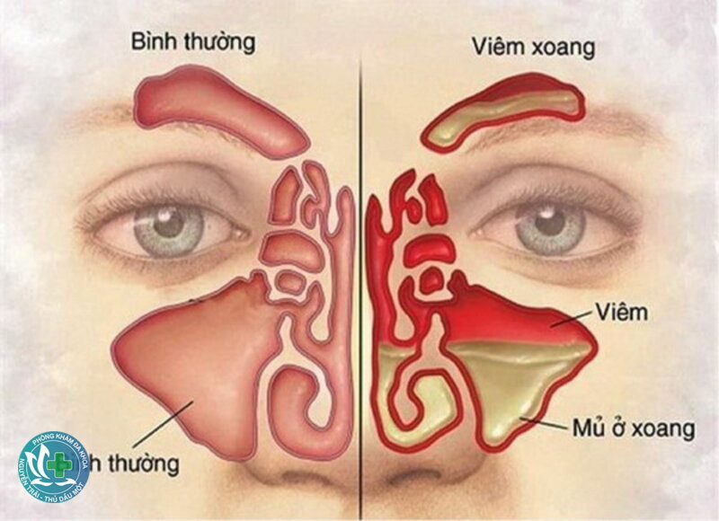 Viêm xoang - Dấu hiệu thường gặp Viêm xoang - Dấu hiệu thường gặp