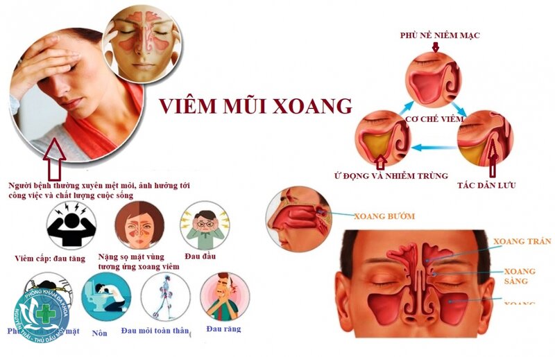 Viêm xoang - Chăm sóc tại nhà Viêm xoang - Chăm sóc tại nhà