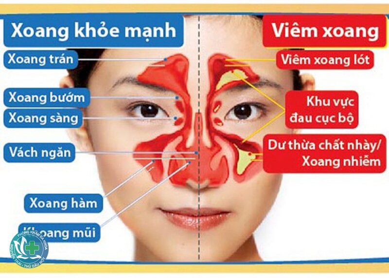 Viêm xoang - Phòng tái phát Viêm xoang - Phòng tái phát