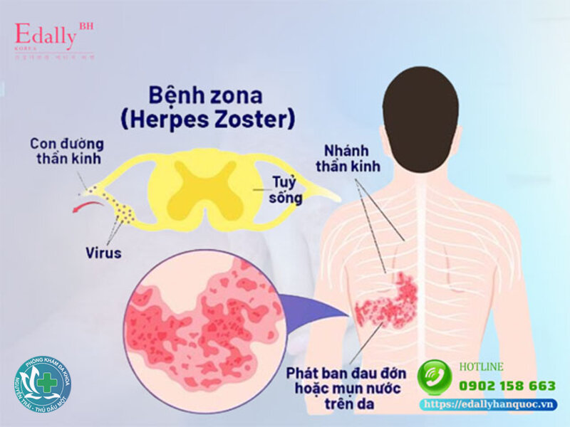 Zona thần kinh - Ai có nguy cơ cao?