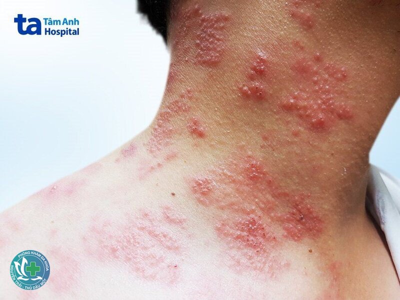 Zona thần kinh - Ban và mụn nước