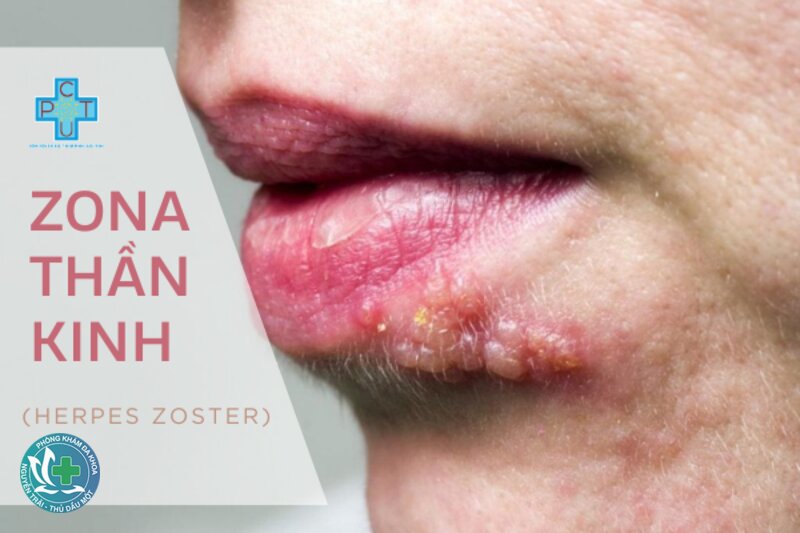 Zona thần kinh - Vì sao cần điều trị sớm?